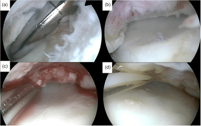Arthroscopic minced-cartilage implantation sequence