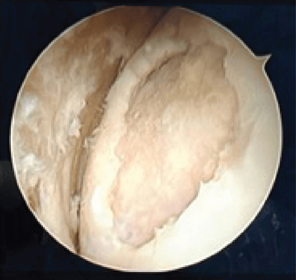 Arthroscopic view of damaged articular cartilage with an irregular, fibrillated surface