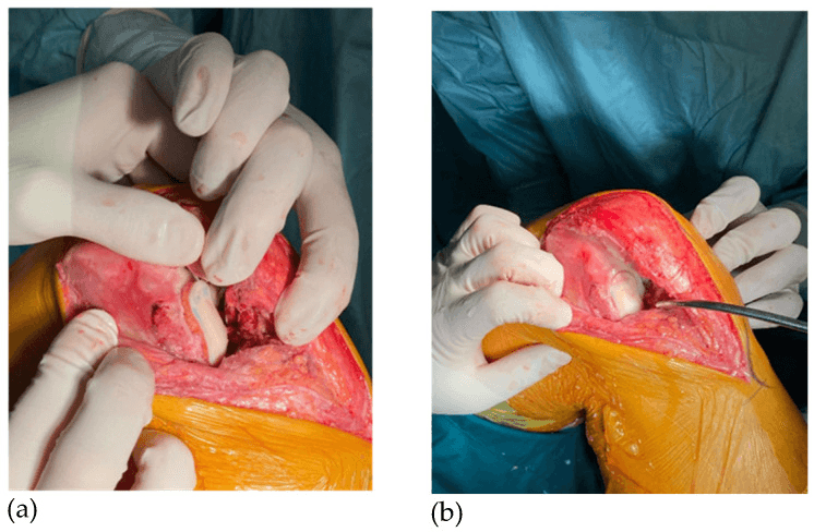 Osteochondral allograft being seated in the recipient bed and checked with an instrument at its margin
