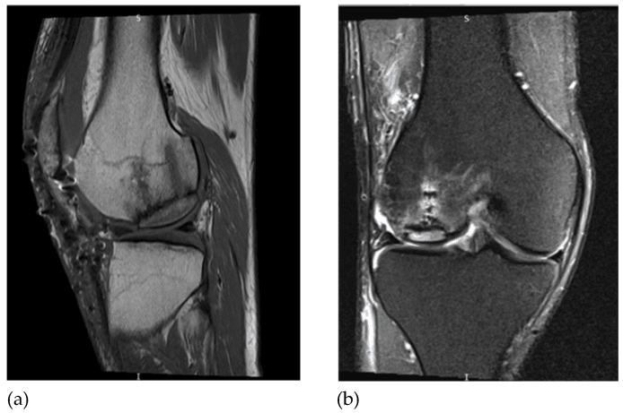 Postoperative sagittal and coronal knee MRI after osteochondral allograft transplantation