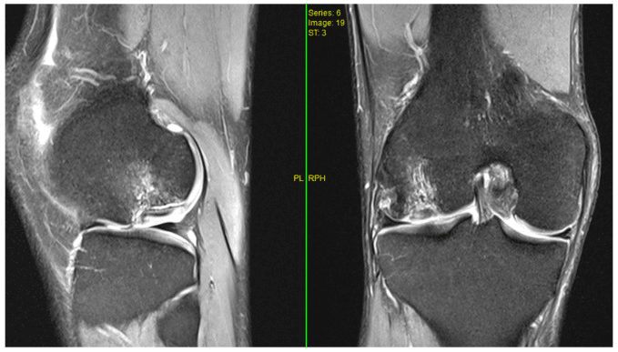 Preoperative sagittal and coronal knee MRI of an osteochondral lesion of the femoral condyle