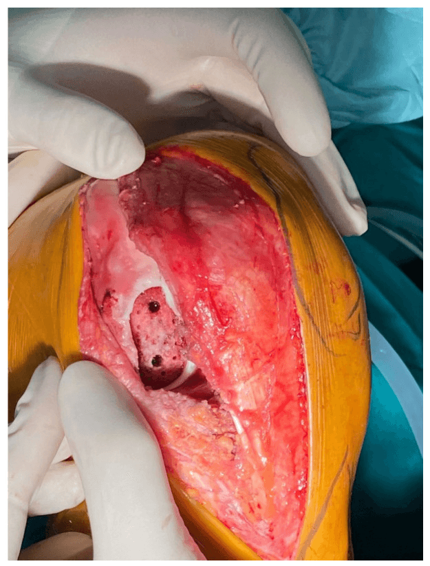 Open arthrotomy showing a prepared recipient bed in the lateral femoral condyle with two drill holes