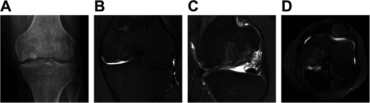 Frontal knee radiograph and coronal, sagittal and axial MRI 22 months after osteochondral grafting