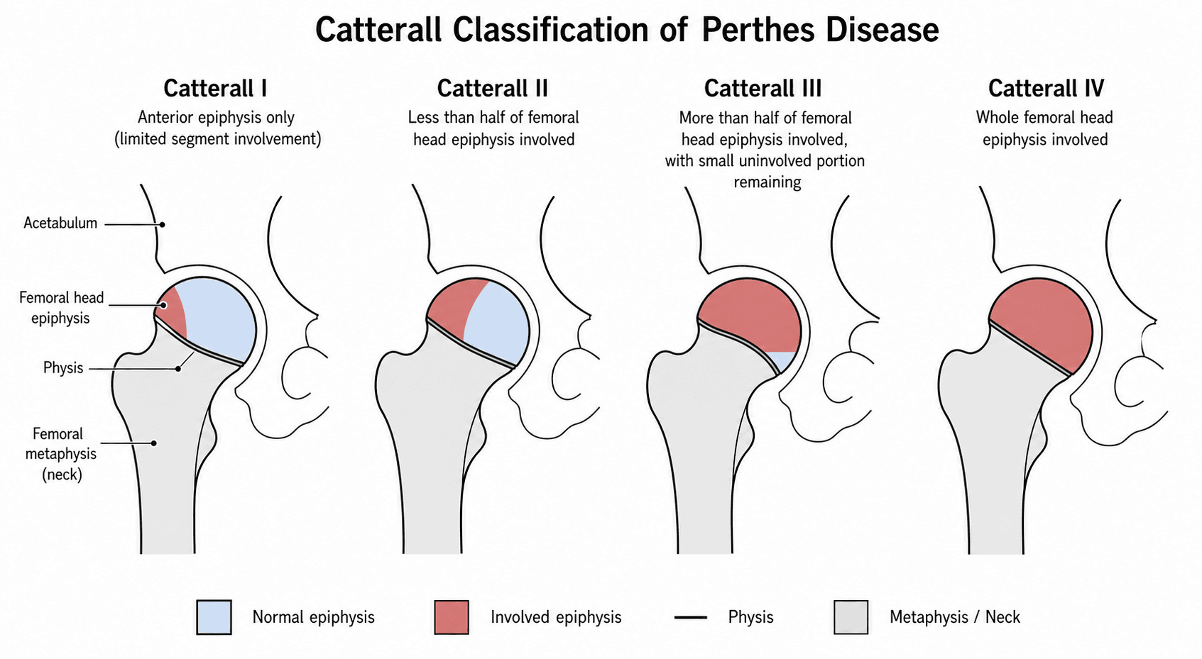 Catterall classification of Perthes disease by extent of femoral head epiphyseal involvement (groups I-IV)