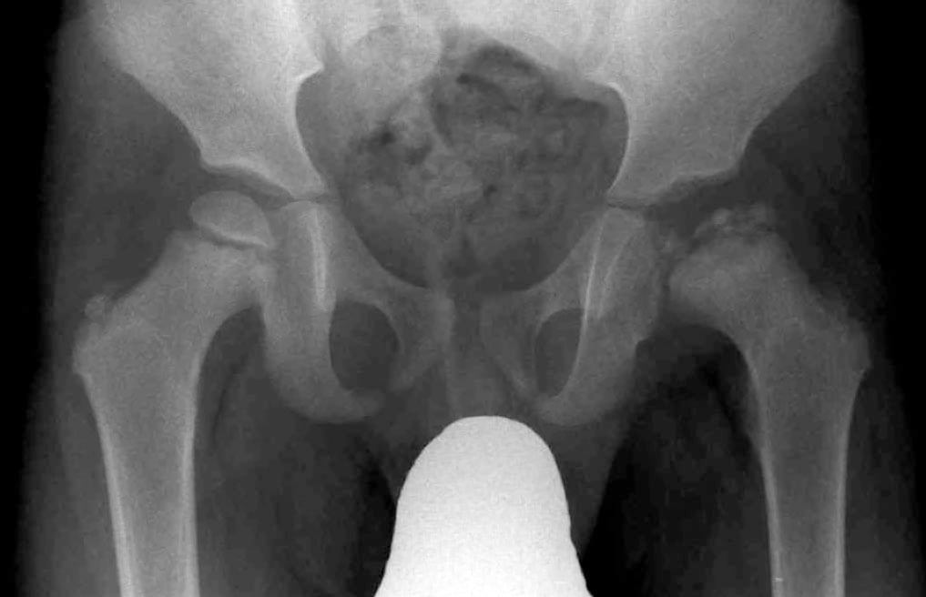 AP pelvis radiograph of a child with Legg-Calvé-Perthes disease showing a flattened, sclerotic, fragmented left capital femoral epiphysis.
