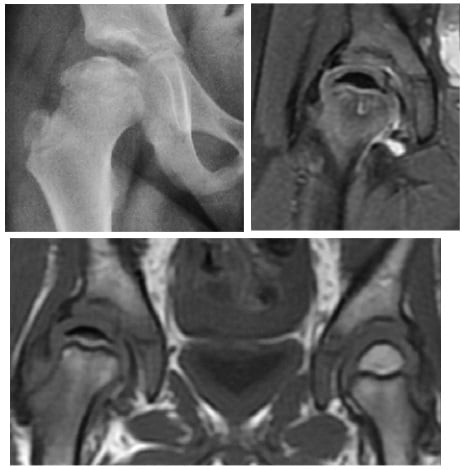 Multimodal imaging of Perthes disease - hip radiograph, fat-saturated PD MRI and coronal T1 MRI showing a flattened, low-signal capital femoral epiphysis