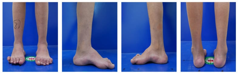 Standing photographs of bilateral cavovarus feet from the front, from each side and from behind