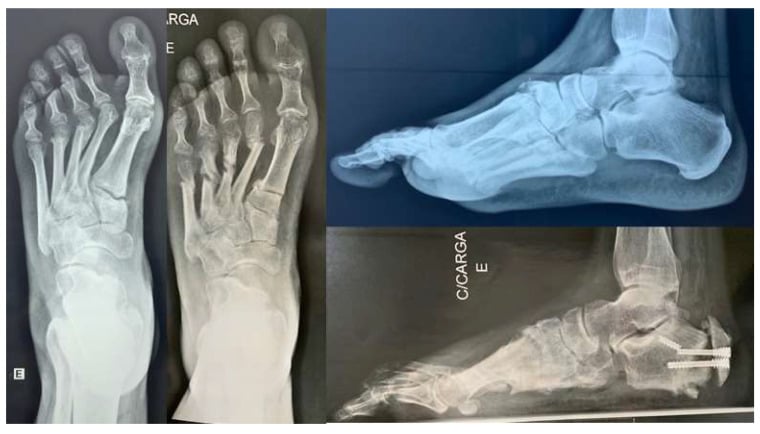 Dorsoplantar and lateral foot radiographs, the lower lateral view showing two screws across a calcaneal osteotomy with a lucent line between the fragments