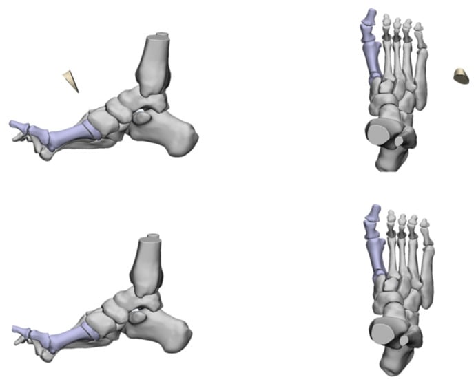 Anatomical schematic diagram of 1st metatarsal dorsal closed wedge osteotomy