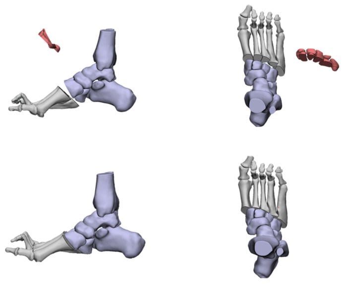 Anatomical schematic diagram of Jahss midfoot tarsal osteotomy