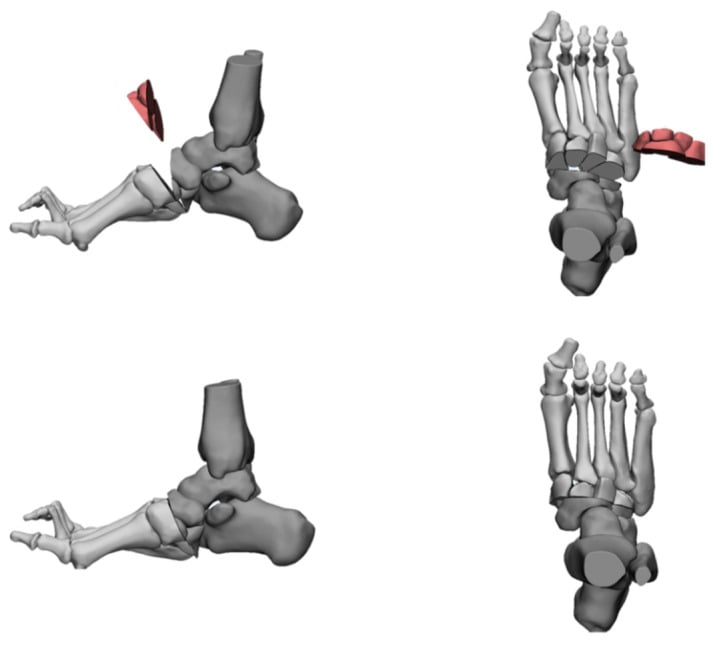 Anatomical schematic diagram of Cole V-shaped tarsal osteotomy