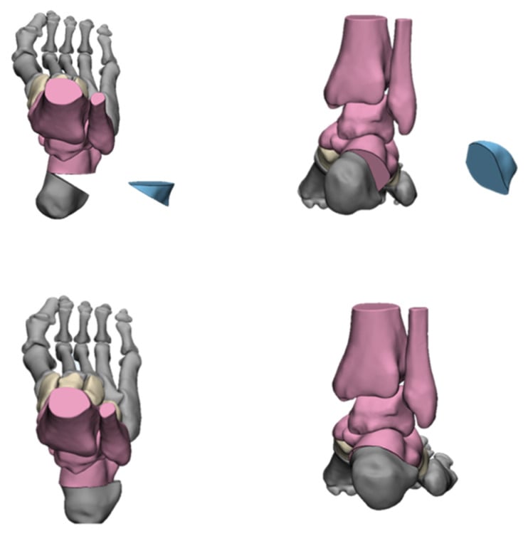 Anatomical schematic diagram of Dwyer lateral closing wedge calcaneal osteotomy