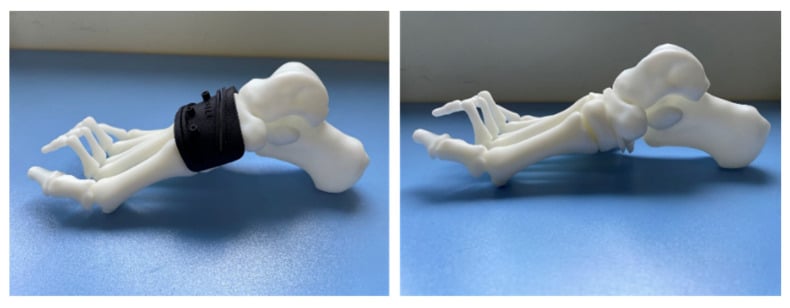 3D printed patient-specific midfoot osteotomy surgical guide for cavus foot correction