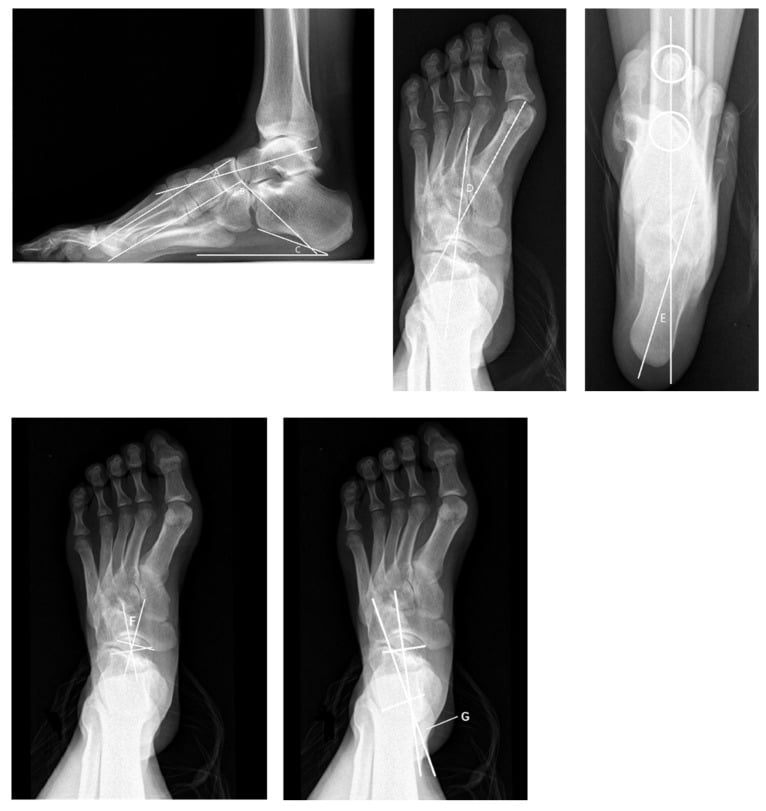 Weight-bearing lateral, dorsoplantar and hindfoot alignment radiographs with seven measurements labelled A to G