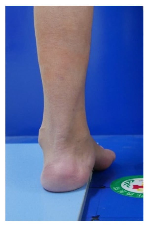 Posterior view of a heel standing on a Coleman block, with the first ray unsupported off the edge of the block