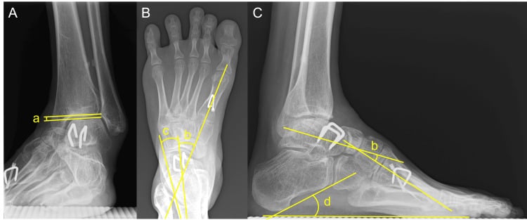 Weight-bearing ankle, dorsoplantar foot and lateral foot radiographs, panels A to C, 24 months after neurological cavovarus reconstruction, with angles a to d marked and staples in place