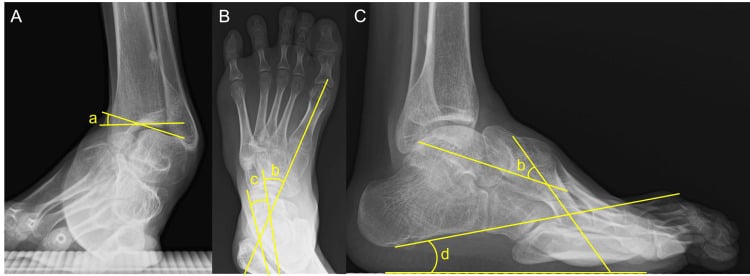 Pre-operative weight-bearing ankle, dorsoplantar foot and lateral foot radiographs, panels A to C, with angles a to d marked