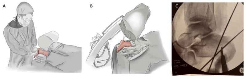 Drawings of the operative set-up (A, B) and a lateral fluoroscopic image (C) with two convergent wires in the calcaneus for a minimally invasive calcaneal osteotomy