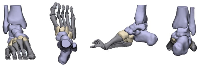 Three-dimensional model of a cavus foot shown from four aspects, with the midfoot shaded cream