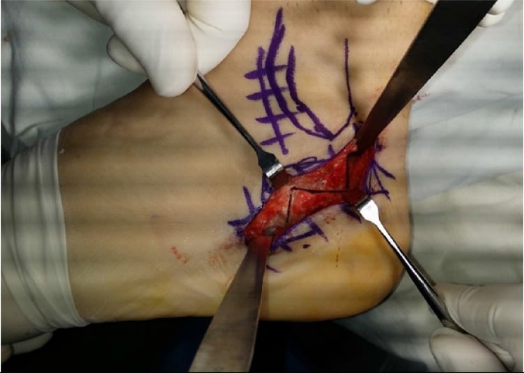 Operative view of a Z-shaped calcaneal osteotomy exposed between retractors, with skin markings on the heel