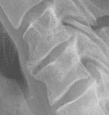 Lateral cervical radiograph showing spondylotic disc degeneration