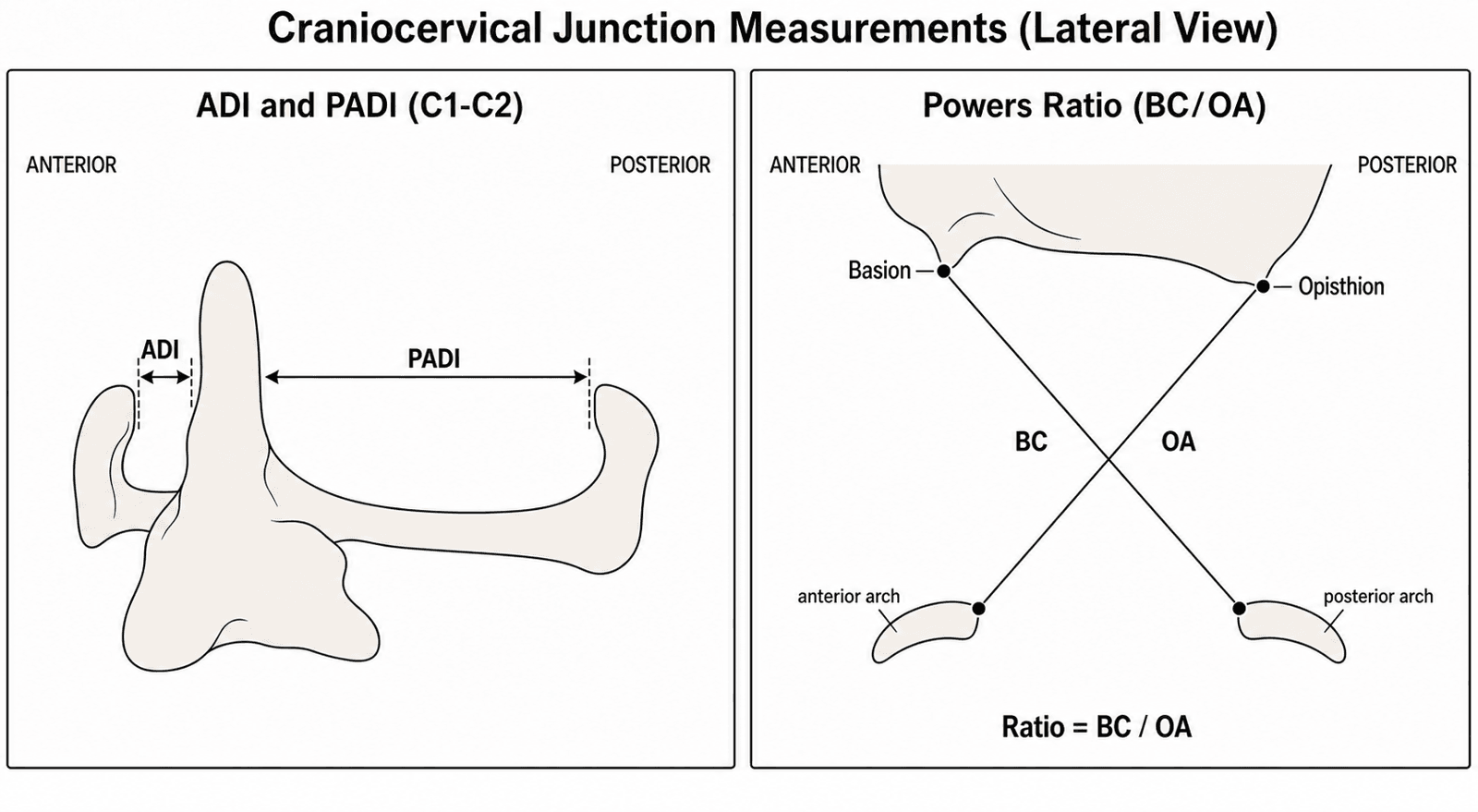 Schematic showing the ADI/PADI measurement and the Powers ratio at the craniocervical junction