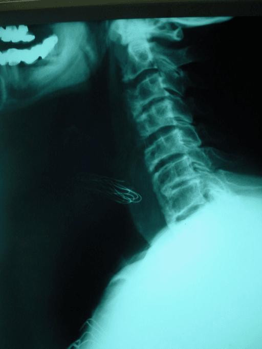 Postoperative lateral cervical spine radiograph