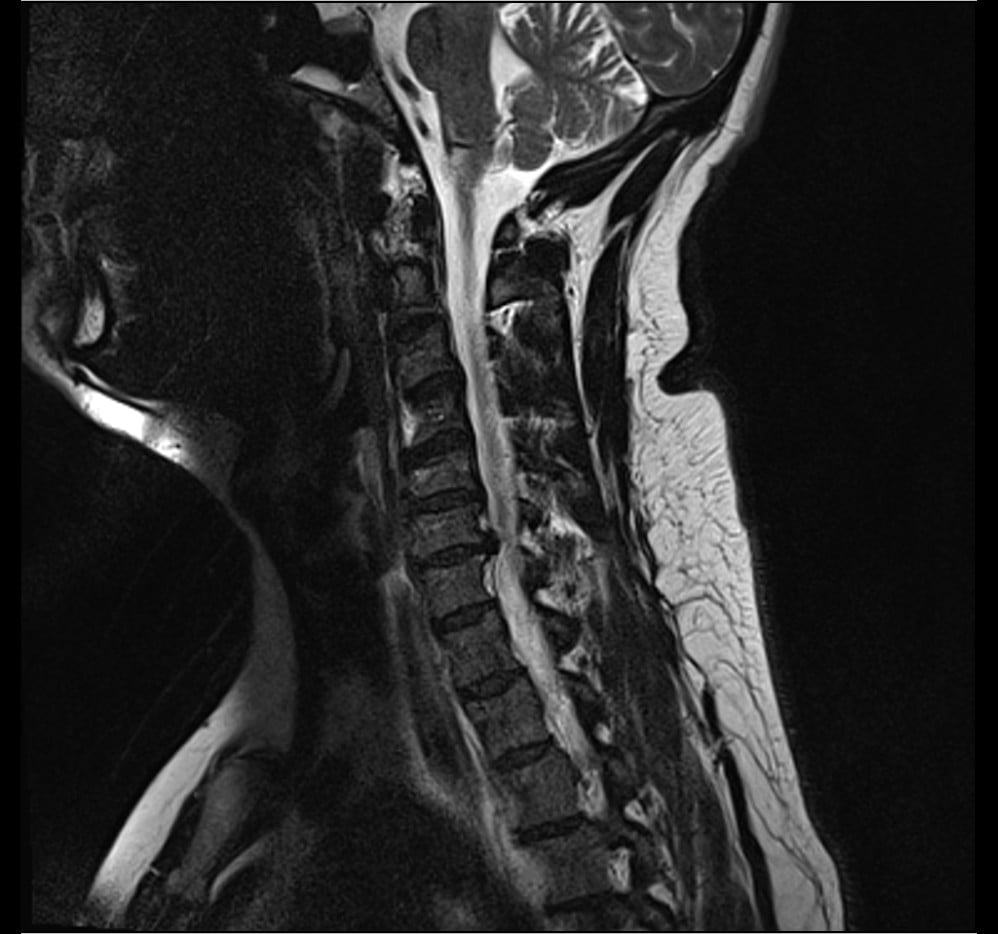 Sagittal T2-weighted MRI of the cervical spine showing multilevel degenerative disc disease with disc protrusions indenting the thecal sac.