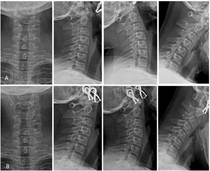 Preoperative T1/T2 MRI and axial CT demonstrating cervical foraminal nerve root stenosis
