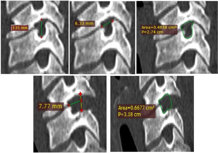 Postoperative MRI and CT demonstrating full endoscopic posterior cervical foraminotomy decompression