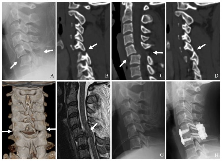 Radiograph, CT and MRI sequence showing bilateral facet dislocation with disc herniation, restored alignment and combined anterior and posterior fixation