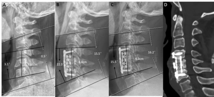 Preoperative and postoperative lateral radiographs with angle and height measurements and a sagittal CT after C5 corpectomy with titanium mesh cage and anterior plate