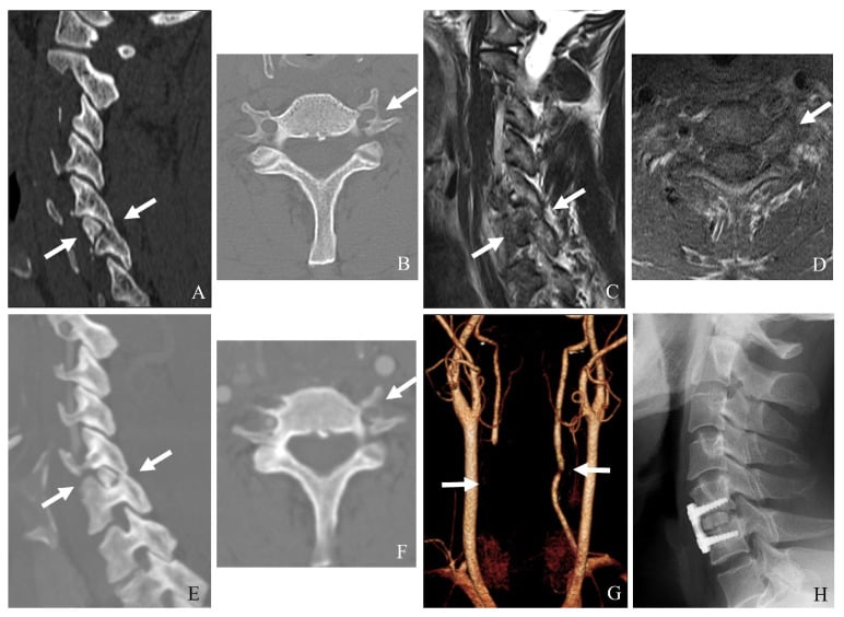 CT, MRI and CT angiography showing facet dislocation, transforaminal fracture and vertebral artery injury, with a postoperative lateral radiograph after anterior fixation