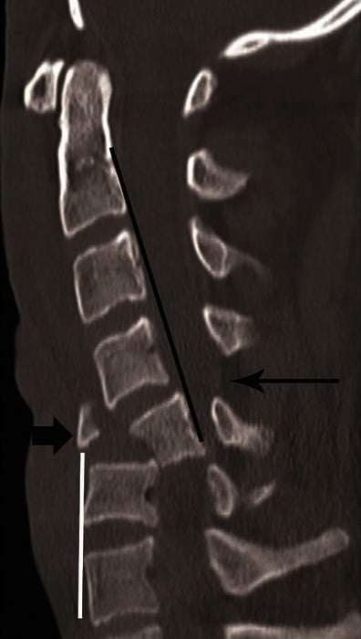 Sagittal CT showing a flexion teardrop fracture of C5 with posterior displacement