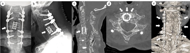 Postoperative radiographs and CT showing long-segment posterior fixation and interbody reconstruction across a fused cervical spine fracture