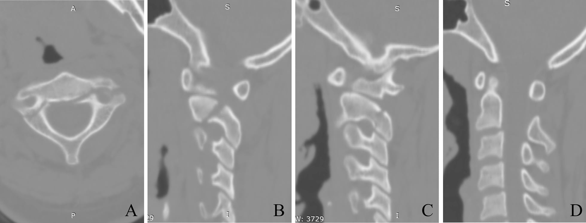 Axial and sagittal CT showing bilateral C2 pars interarticularis fractures in a hangman fracture