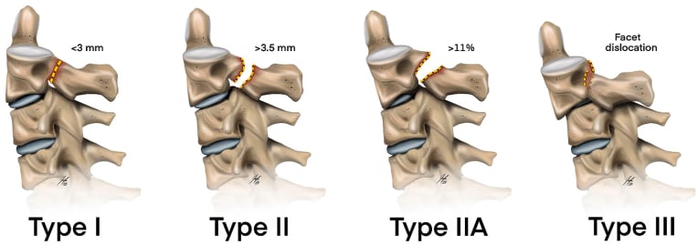 Illustrated Levine and Edwards classification of hangman fracture types I, II, IIA and III