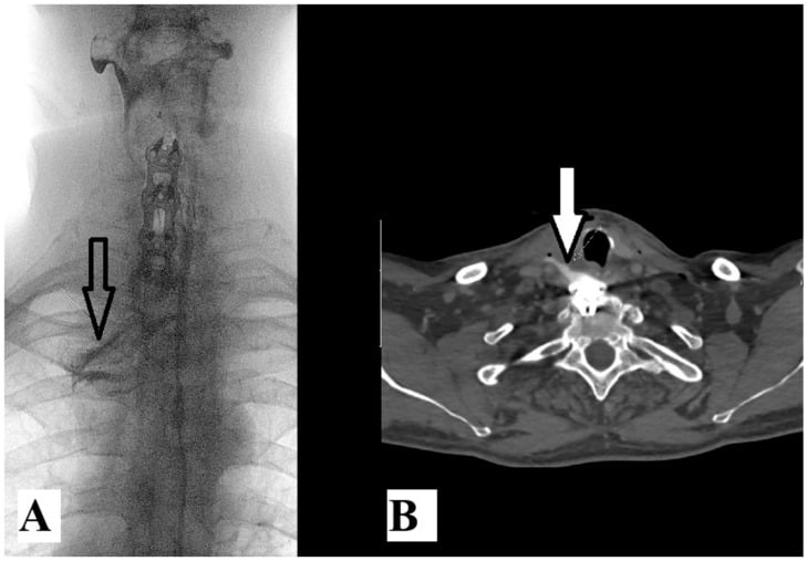 Water-soluble contrast swallow and axial CT showing contrast leak from an oesophageal perforation after cervical fixation