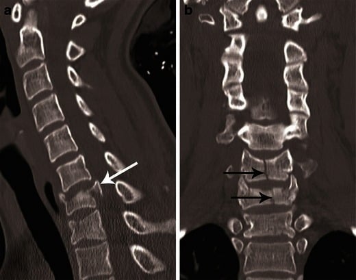 Sagittal and coronal CT showing a comminuted C7 burst fracture with retropulsion