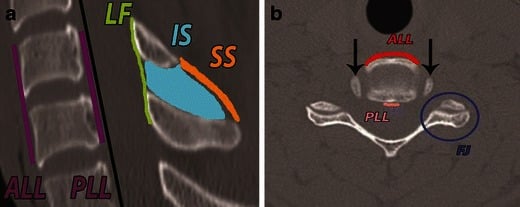 Colour-coded sagittal and axial CT schematic of the subaxial cervical disco-ligamentous complex, labelling the ALL, PLL, ligamentum flavum, interspinous and supraspinous ligaments and facet joint