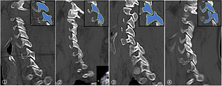 Parasagittal CT sequence showing separated, perched, locked and fractured cervical facets
