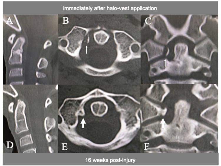 Serial sagittal, axial and coronal CT showing a C1 transverse ligament bony avulsion immediately after halo-vest application and united at 16 weeks