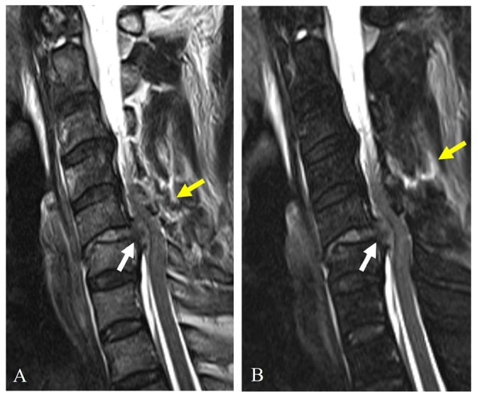 Sagittal MRI showing traumatic C5–6 disc rupture, cord compression and posterior ligamentous injury