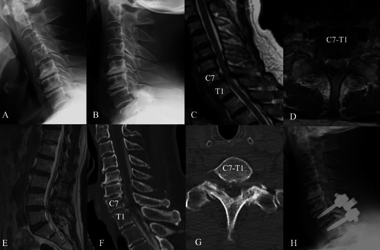 Flexion-extension radiographs, CT and MRI of C7–T1 spondylolisthesis with myelopathy, with a lateral radiograph after instrumentation