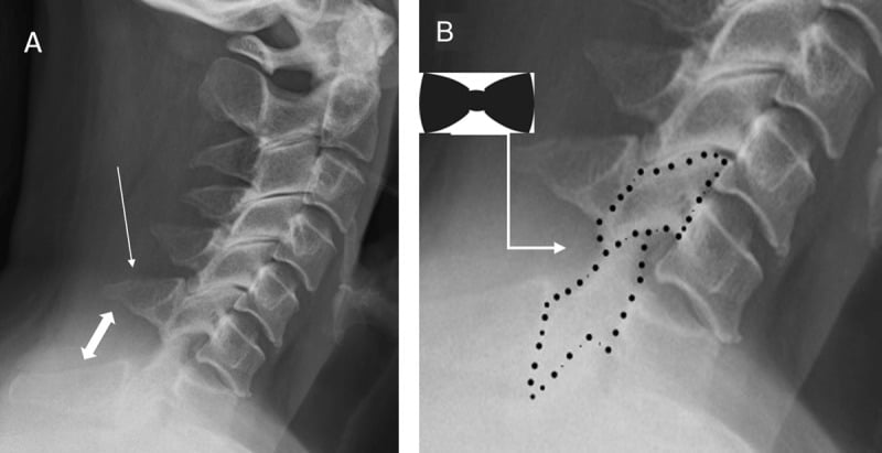 Grade-one C6–C7 traumatic anterolisthesis on lateral radiographs, with arrows at the slipped level and a bow-tie inset over dotted facet outlines