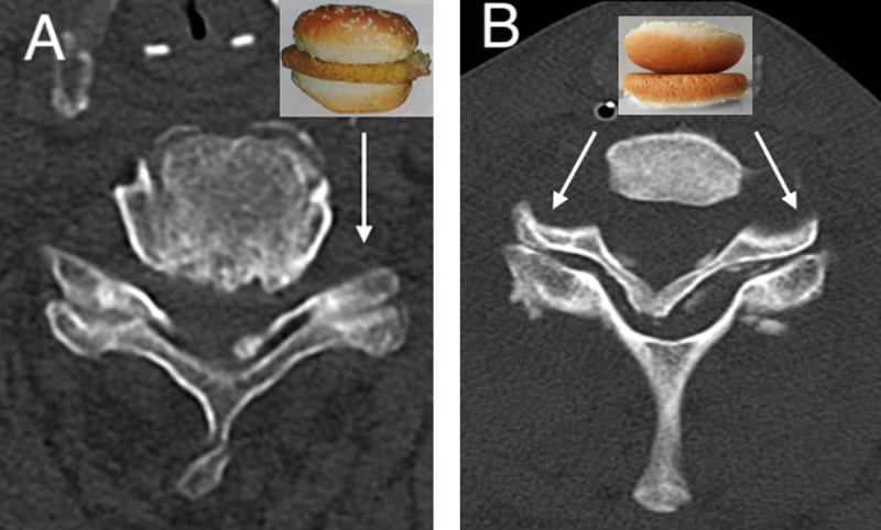 Axial CT showing normal hamburger-bun and reversed naked-facet configurations
