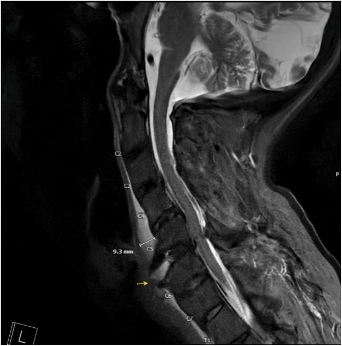Sagittal T2-weighted MRI, levels labelled, of a traumatic grade-one C5–C6 retrolisthesis