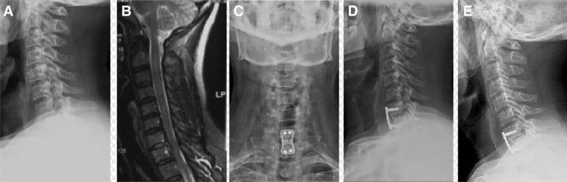 C7–T1 spondylolisthesis and cord compression before and after anterior fusion
