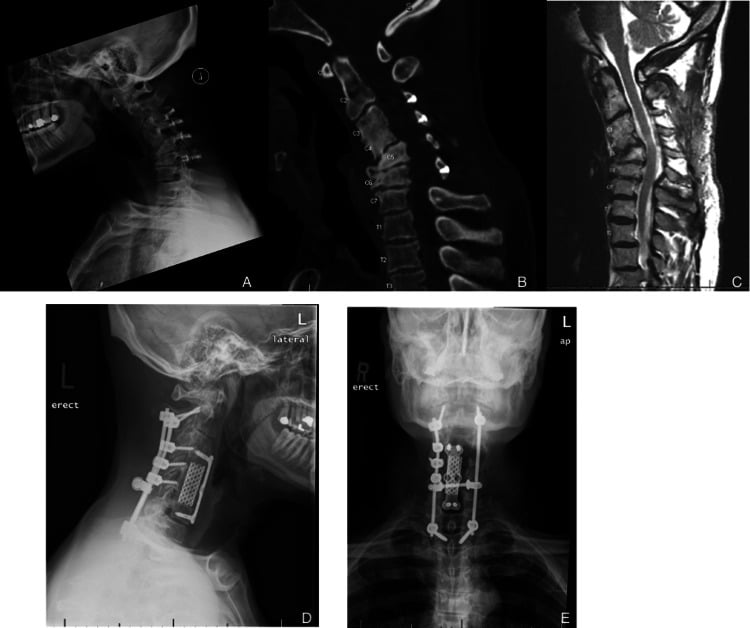 Post-laminoplasty swan-neck deformity before and after staged anterior release and posterior fixation