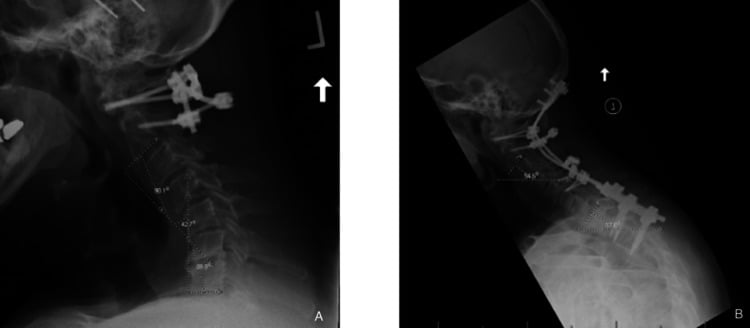 Mobile chin-on-chest deformity after short upper-cervical fusion and its revision
